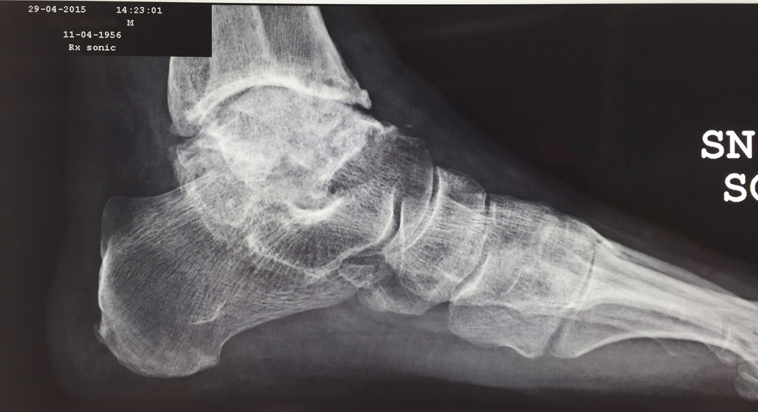 Chirurgia-protesi-di-caviglia