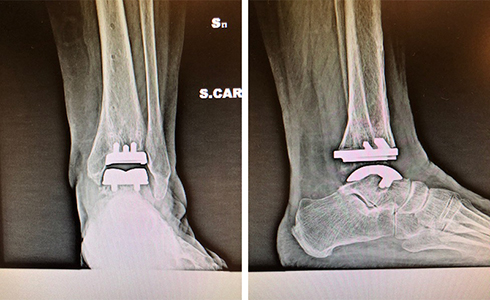 Intervento-chirurgico-protesi-caviglia-roma-XRay