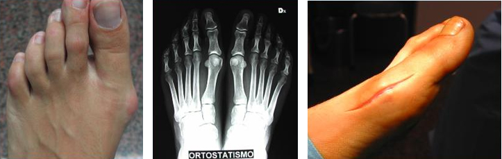 Alluce-valgo-osteotomia-distale-dott-Gianluca-Falcone-Roma