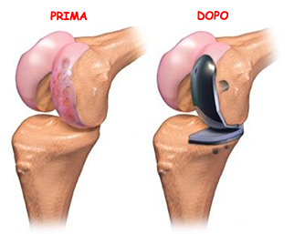 Protesi-ginocchio_2_dott-Gianluca-Falcone-chirurgo-ortopedico-Roma