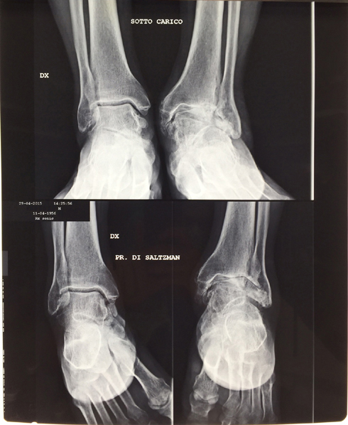 Chirurgia-protesi-di-caviglia