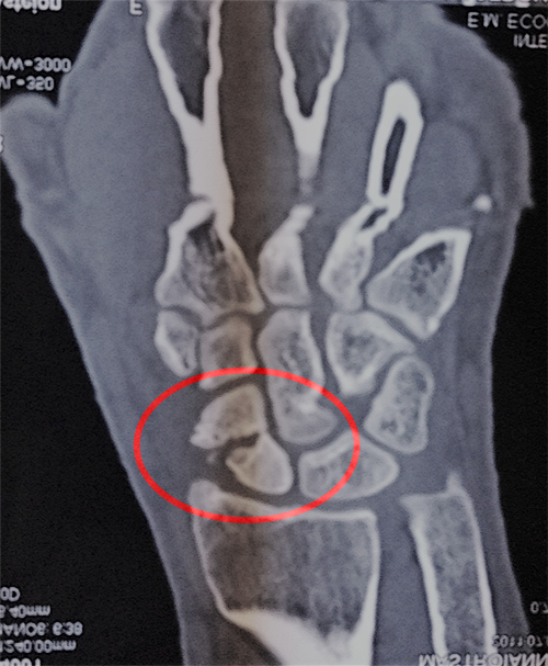 Frattura-scafoide_dott-gianluca-falcone-roma