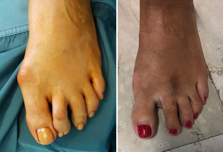 Chirurgia-percutanea-mini-invasiva-alluce-valgo_caso-4-pre-e-post