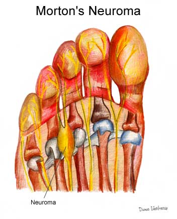 Intervento-chirurgico-neuroma-di-morton-roma