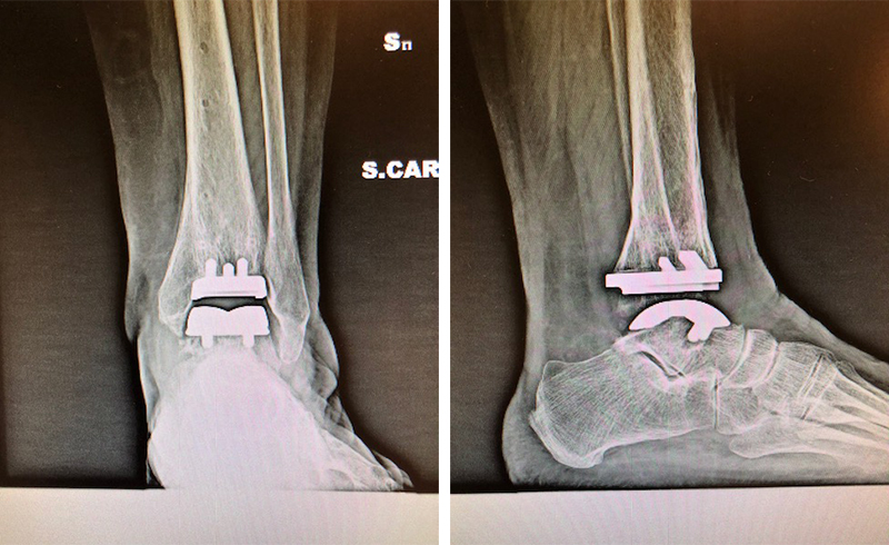 Intervento-chirurgico-protesi-caviglia-XRay_Dott-Gianluca-Falcone-Roma