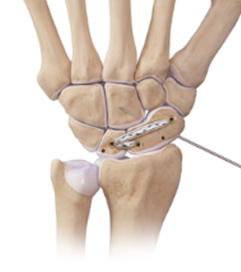 Lesione-Scafo-lunato-immagine-schematica_4a_patolgie-polso_dott-gianluca-falcone-medico-chirurgo-roma