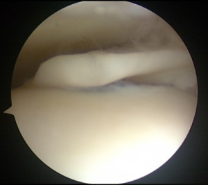 Lesioni-osteocondrali-astragalo-artroscopia_3_dott-Gianluca-Falcone-Roma