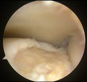 Lesioni-osteocondrali-astragalo-artroscopia_4_dott-Gianluca-Falcone-Roma