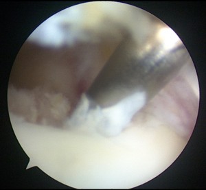 Lesioni-osteocondrali-astragalo-artroscopia_5_dott-Gianluca-Falcone-Roma