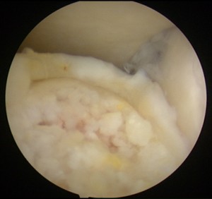 Lesioni-osteocondrali-astragalo-artroscopia_6_dott-Gianluca-Falcone-Roma