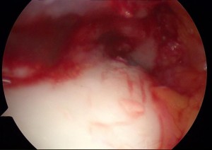 Lesioni-osteocondrali-astragalo-artrosopia_7_dott-Gianluca-Falcone-Roma