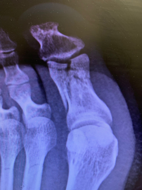 Osteosintesi-con-placca-frattura-articolare-falange_dott-Gianluca-Falcone