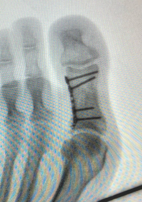 Osteosintesi-con-placca-frattura-articolare-falange_dott-Gianluca-Falcone