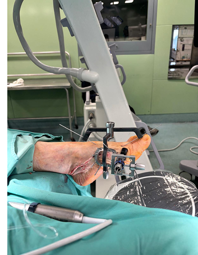 Tarsoplasty_Tecnica-percutanea-per-correggere-deformita-alluce_dott-Gianluca-Falcone
