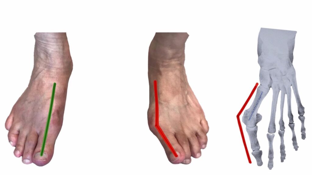 Tecnica-mininvasiva-per-alluce-valgo-MICA_dott-Gianluca-Falcone