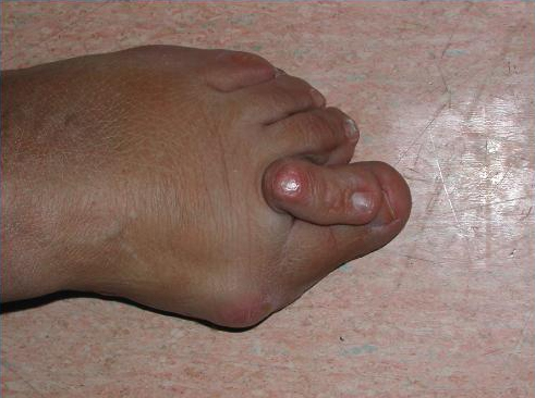 capsulite_dott-Gianluca-Falcone-medico-chirurgo-Roma