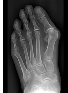 metatarsalgia-piede-intervento-chirurgico_10_dott-Gianluca-Falcone