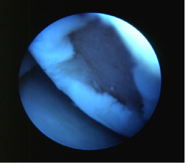 Artroscopia-ginocchio_5_dott-Gianluca-Falcone-Roma