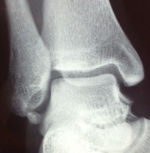 Lesioni-osteocondrali-astragalo_1_dott-Gianluca-Falcone-Roma