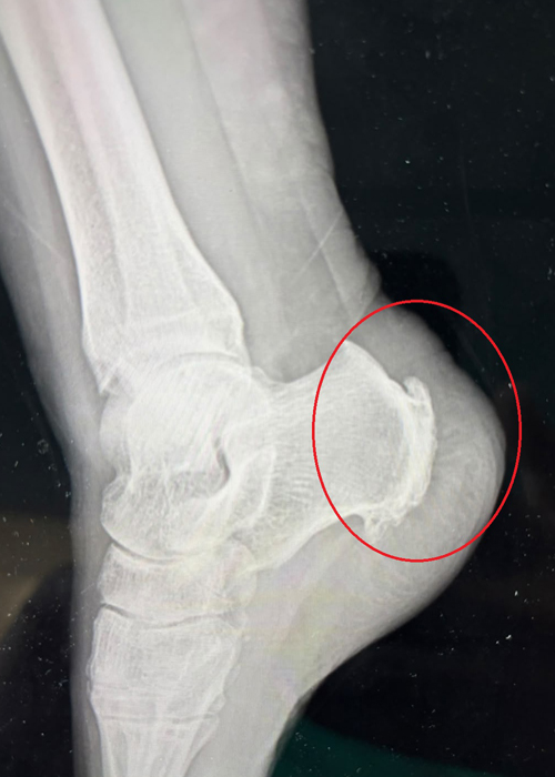 Osteotomia-di-Zadek-per-tendinopatie-achillee-inserzionali_1_Dott-Gianluca-Falcone-Roma