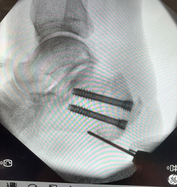Osteotomia-di-Zadek-per-tendinopatie-achillee-inserzionali_3_Dott-Gianluca-Falcone-Roma