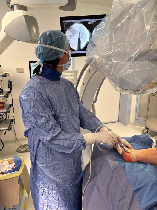 Osteotomia-di-Zadek-per-tendinopatie-achillee-inserzionali_4_Dott-Gianluca-Falcone-Roma