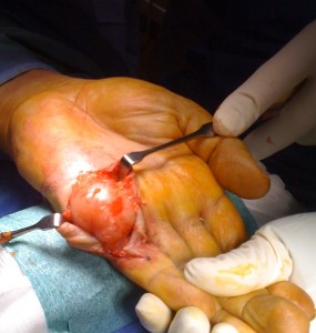 Tumori-mano-e-polso_1_dott-Gianluca-Falcone-Roma